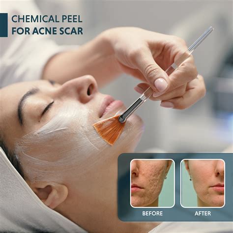skin peel ballito|Acne and Acne Scars .